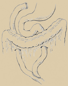 Fig. 4 Dissezione della placca ilare fibrosa